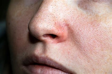According to Byrdie, there are several ways you can treat your sebaceous filaments at home without seeing a professional or spending an exorbitant amount of money. . Sebaceous filaments pictures